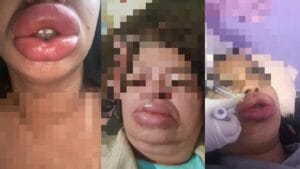 Falsa biomédica é indiciada após deformar bocas de pacientes em Campo Grande Ana Carolina Brites é investigada por procedimentos ilegais