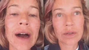 Vídeo: Luana Piovani mostra rosto com descamação nas redes sociais