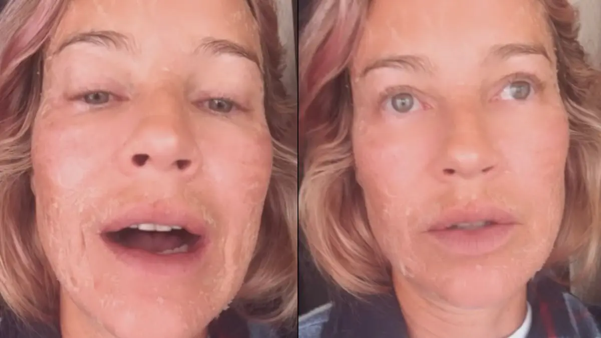 Vídeo: Luana Piovani mostra rosto com descamação nas redes sociais